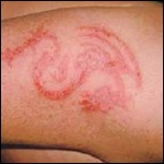 dermatosis adolescente dermatosis adolescente