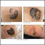 melanoma melanoma