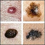 El ABCD para reconocer entre un lunar benigno y un melanoma. The University of Chicago Medical Center