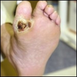 Intervenciones complejas para la prevención de la úlcera del pie diabético. Biblioteca Cochrane Plus 2010
