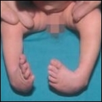 Deformidades del pie. Anales Pediatría 2006