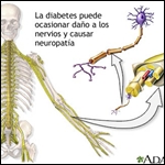 Guía Práctica en el manejo de la Polineuropatía diabética NEURALAD 2010