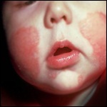 Dermatitis atópica en niños: estudio comparativo en dos grupos etarios. Rev. chil. pediatr. 2011