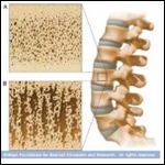 Prevención de Osteoporosis. Rev. Med. Clin. Condes – 2010