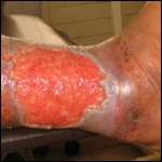 Tratamiento de la insuficiencia (úlcera) venosa crónica. 2011