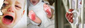 Evaluación y tratamiento de las quemaduras en la niñez
