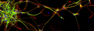 Espectro clínico y valor diagnóstico de los anticuerpos contra el complejo proteico asociado a canales de potasio, Neurología. 2015.