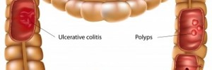 Obstrucción intestinal como comienzo de la enfermedad de Crohn,  med. gen. y fam . 2015.