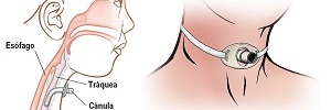 Procedimiento de traqueostomía percutánea: control y seguimiento de enfermería, Enferm Intensiva- 2009