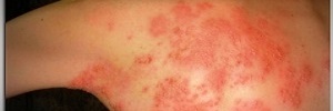 Dolor en el herpes zóster: prevención y tratamiento, Semergen- 2016