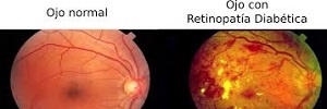 Cribado de retinopatía diabética en atención primaria, Semergen- 2016