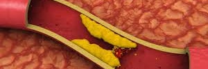 La auténtica dimensión del colesterol-no-HDL: colesterol aterogénico, Clin Investig Arterioscler- 2016