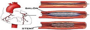 Angioplastia primaria en diabéticos vs no diabéticos con infarto agudo de miocardio: predictores de mortalidad, Arch Cardiol Mex- 2016