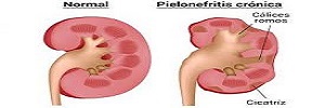 Cicatrices renales en menores de 36 meses ingresados por pielonefritis aguda, An Pediatr (Barc)- 2017