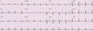 Reconocimiento electrocardiográfico de una dextrocardia, Aten primaria-2017
