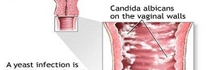 Prevalencia de Candida albicans y su relación con cambios en el pH vaginal, Aten fam- 2017