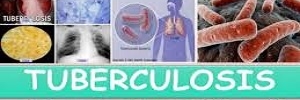 Tuberculosis, Rev med clin condes- 2014