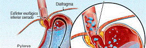 Manejo del reflujo gastroesofágico en niños, An Pediatr (Barc)- 2017