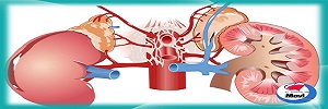 Enfermedad renal crónica y dislipidemia, Clin Investig Arterioscler- 2017