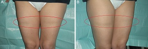 Lipoatrofia semicircular, Semergen- 2017