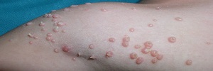 Molusco contagioso por trasmisión vertical, An Pediatr (Barc)- 2017