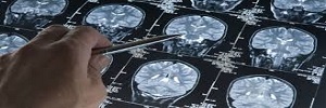 Epidemiología de tumores cerebrales, rev med clin Condes-2017