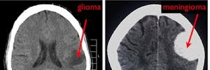 Evaluación de gliomas por técnica avanzada de resonancia magnetica, rev med clin Condes- 2017