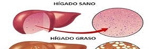 Enfermedad del hígado graso no alcohólico, asociación con la enfermedad cardiovascular y tratamiento (II), Clin Investig Arterioscler- 2017