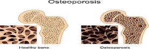 Osteoporosis y el modelo FRIDEX: cómo y cuándo intervenir farmacológicamente en la prevención primaria de fracturas, Aten primaria- 2017