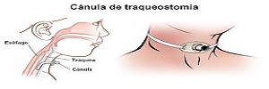 Guías basadas en la evidencia para el uso de traqueostomía en el paciente crítico, med intensiva- 2017