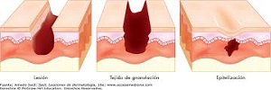 Antibióticos Y Antisépticos Para Las Heridas Quirúrgicas Con Cicatrización  Por Segunda Intención, Revisión Sistemática Cochrane Library 2017 -  EnfermeriaAPS