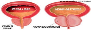 Sintomatología urinaria en pacientes con hiperplasia prostatica posterior  a una intervención educativa