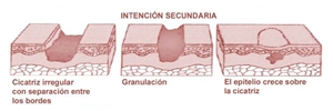 Antibióticos y antisépticos para las heridas quirúrgicas con cicatrización por segunda intención  Revisión Sistemática Cochrane 2016