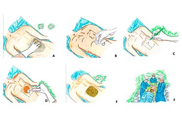 Recomendaciones prácticas para la antisepsia de la piel del paciente antes de cirugía. Infectio 2017