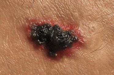 Melanoma en Chile ¿Cuál es nuestra realidad? . Rev. Med. Clin. Condes 2018