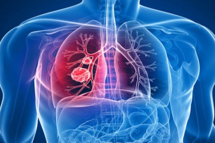Tromboembolismo pulmonar masivo paciente neumonía COVID-19 positivo Rev Chil Anest 2020