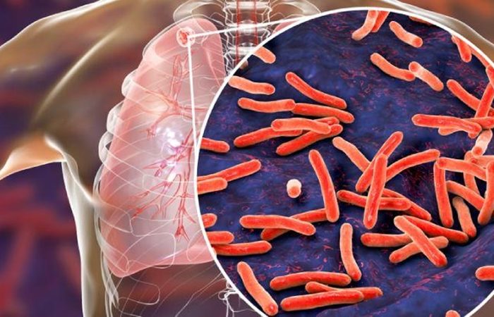 Perfil biopsicosocial del paciente con tuberculosis y factores asociados a la adherencia terapéutica Rev Chil Enferm Respir 2020